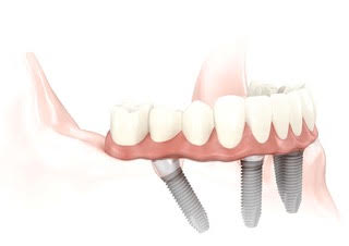 What are the benefits of dental implants?