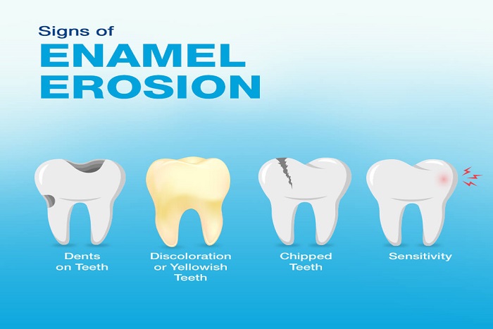 dental erosion