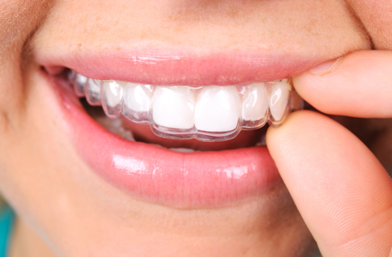How to look after Invisalign braces