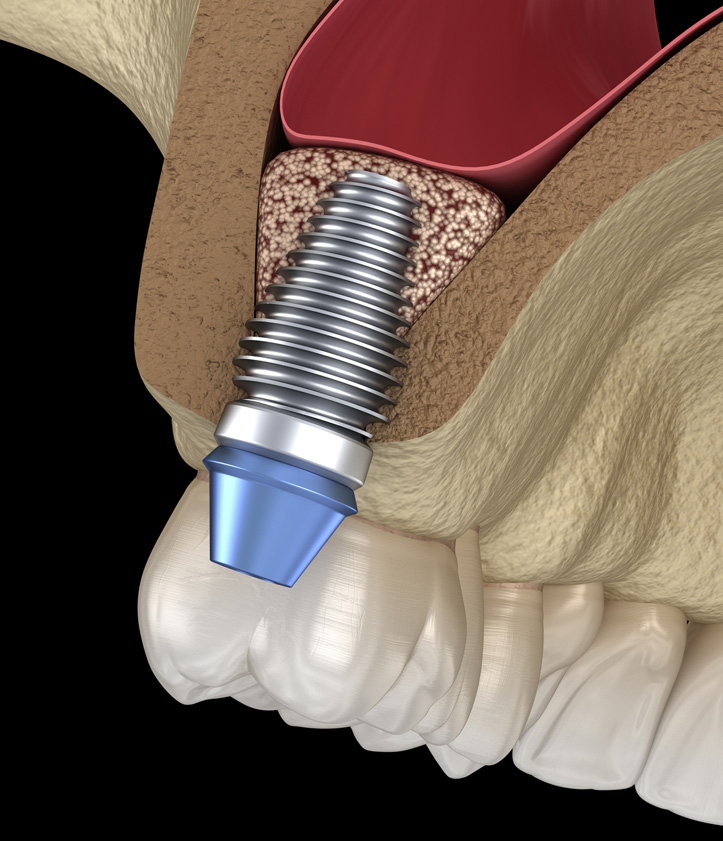 Materials Used in Sinus Grafting